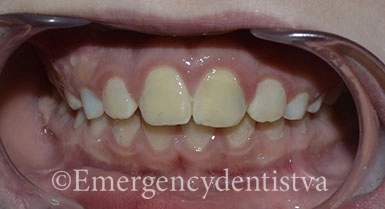 Teeth reinserted after being avulsed.