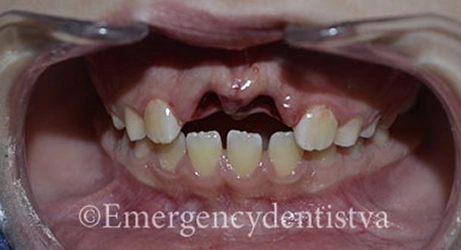 Avulsed teeth accident before being re-implanted.