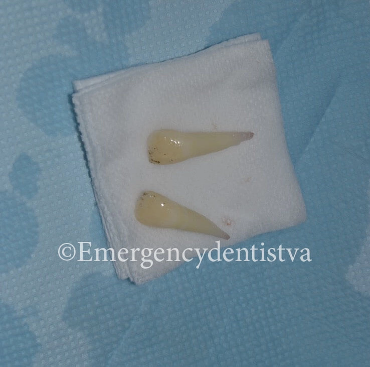 Avulsed teeth on cotton.