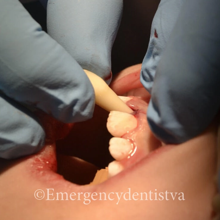 Avulsed tooth being reinserted