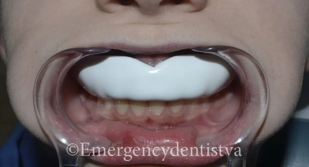 Close-up of child being fit with a custom sports guard.